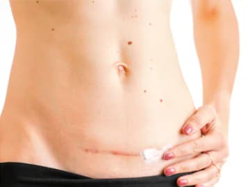 Frau mit einer Narbe am Bauch