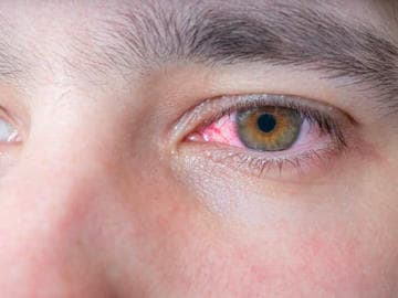 Gerötetes Auge aufgrund einer Bindehautentzündung