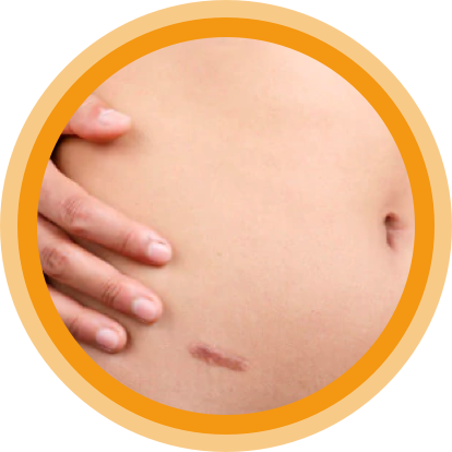 Frau hat Narbe am Bauch: Zu einer Narbenbildung kann es überall am Körper kommen.